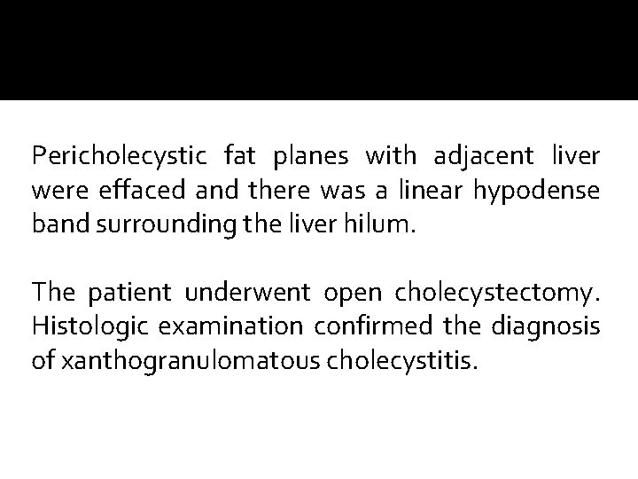 Pericholecystic fat planes with adjacent liver were effaced and there was a linear hypodense Pericholecystic fat planes with adjacent liver were effaced and there was a linear hypodense