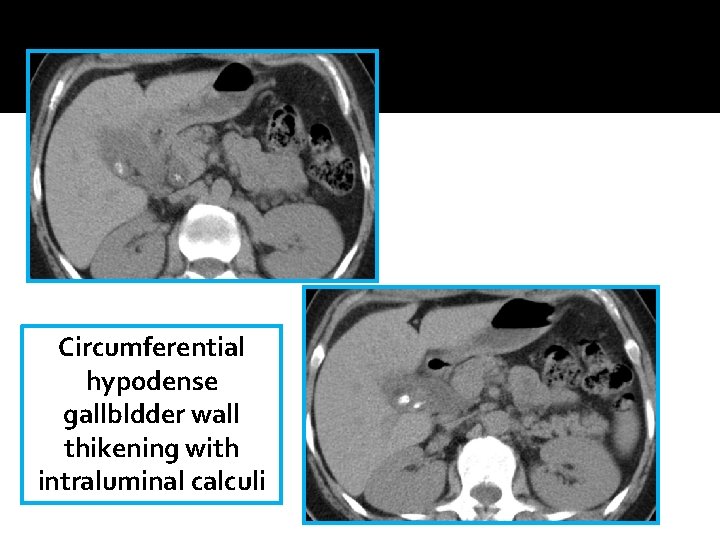 Circumferential hypodense gallbldder wall thikening with intraluminal calculi Circumferential hypodense gallbldder wall thikening with intraluminal calculi