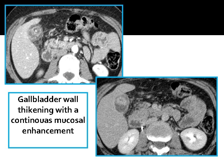 Gallbladder wall thikening with a continouas mucosal enhancement Gallbladder wall thikening with a continouas mucosal enhancement