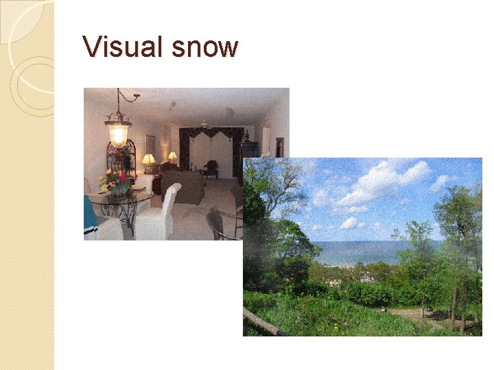 Visual snow 