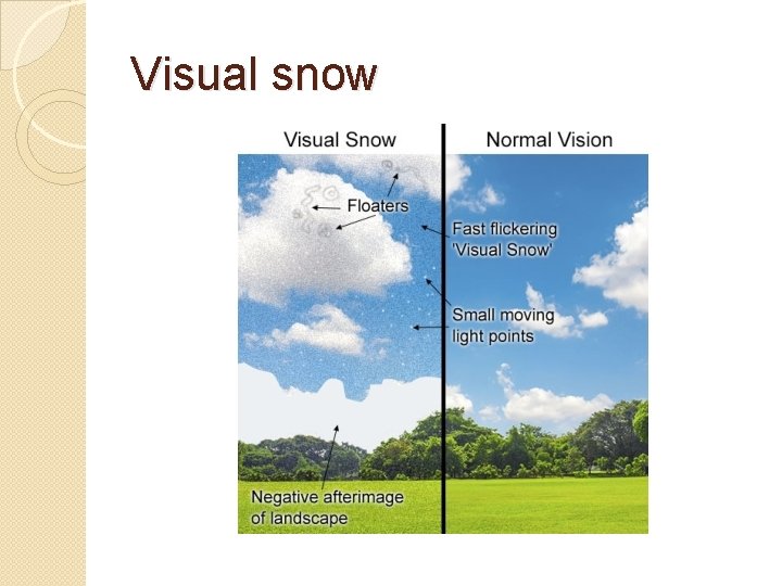 Visual snow 