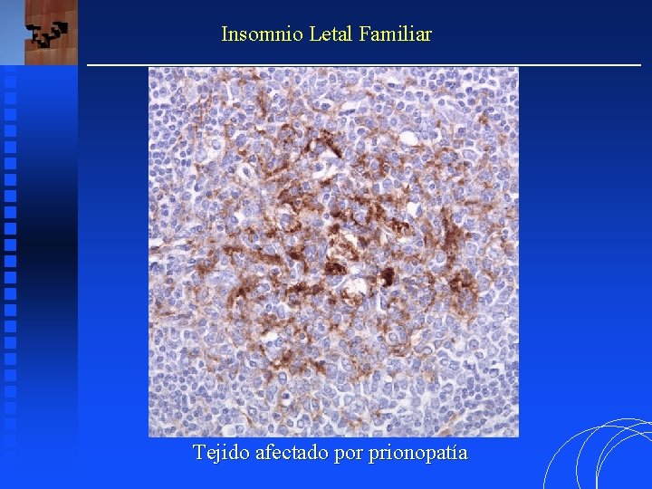 Insomnio Letal Familiar Tejido afectado por prionopatía 