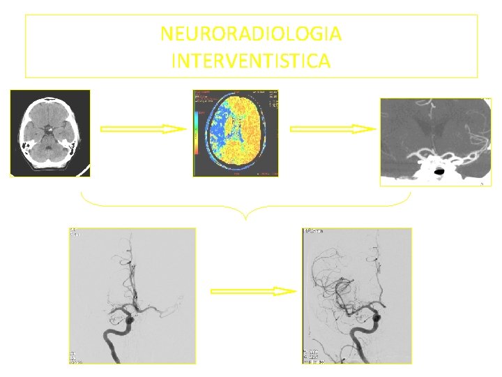 NEURORADIOLOGIA INTERVENTISTICA 