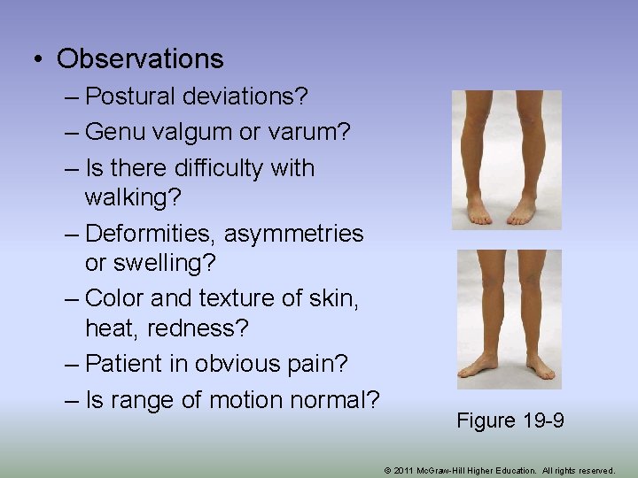  • Observations – Postural deviations? – Genu valgum or varum? – Is there