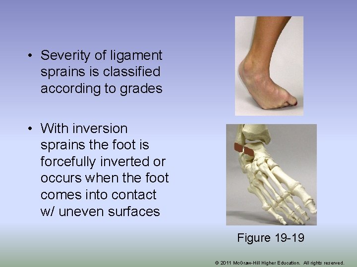  • Severity of ligament sprains is classified according to grades • With inversion