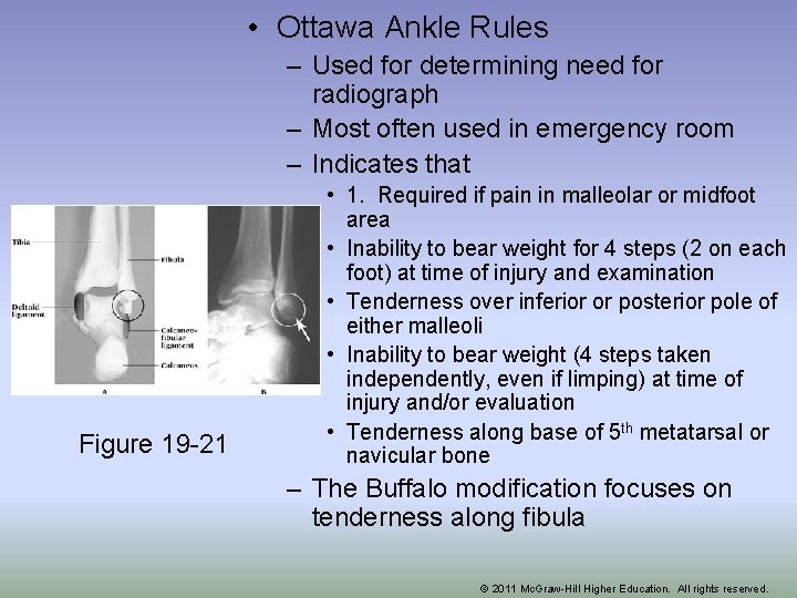  • Ottawa Ankle Rules – Used for determining need for radiograph – Most