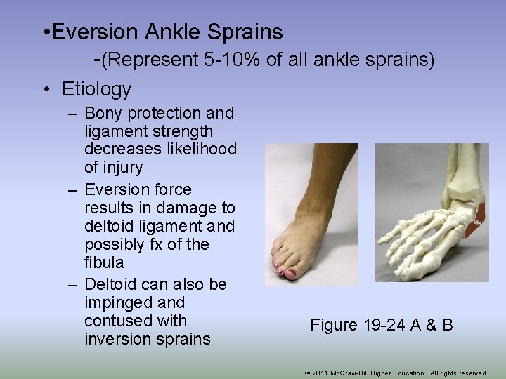  • Eversion Ankle Sprains -(Represent 5 -10% of all ankle sprains) • Etiology