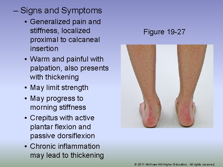 – Signs and Symptoms • Generalized pain and stiffness, localized proximal to calcaneal insertion