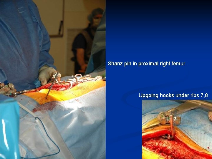 Shanz pin in proximal right femur Upgoing hooks under ribs 7, 8 Shanz pin in proximal right femur Upgoing hooks under ribs 7, 8