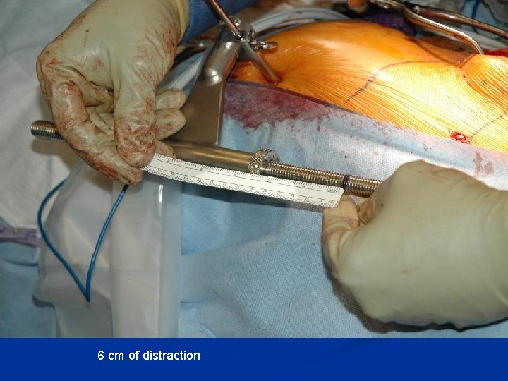 6 cm of distraction 6 cm of distraction