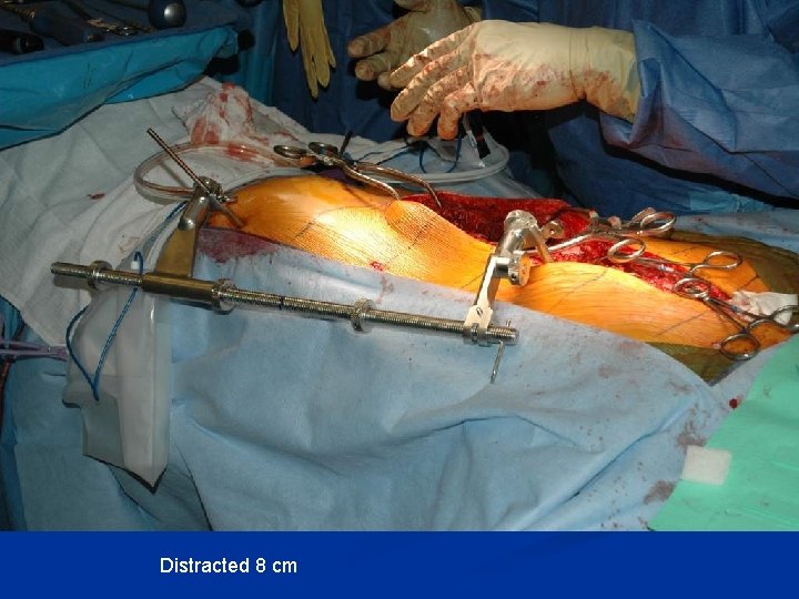 Distracted 8 cm Distracted 8 cm