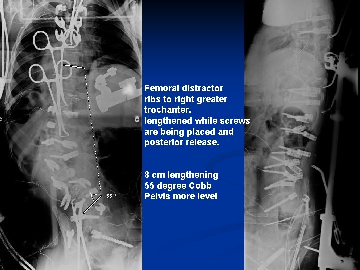 Femoral distractor ribs to right greater trochanter. lengthened while screws are being placed and Femoral distractor ribs to right greater trochanter. lengthened while screws are being placed and