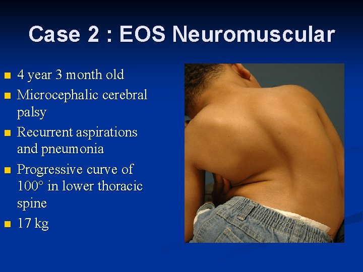 Case 2 : EOS Neuromuscular n n n 4 year 3 month old Microcephalic Case 2 : EOS Neuromuscular n n n 4 year 3 month old Microcephalic