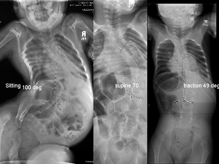 Sitting 100 deg supine 70 traction 49 deg Sitting 100 deg supine 70 traction 49 deg