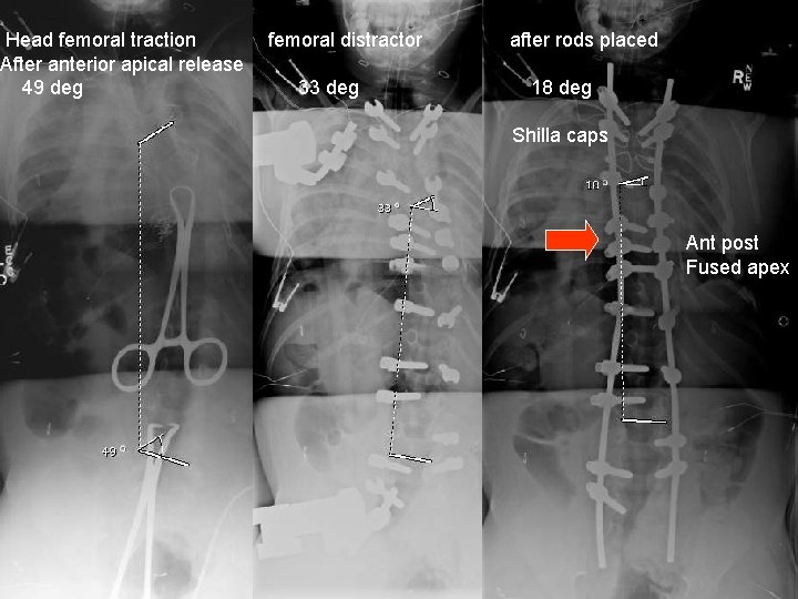 Head femoral traction After anterior apical release 49 deg femoral distractor 33 deg after Head femoral traction After anterior apical release 49 deg femoral distractor 33 deg after