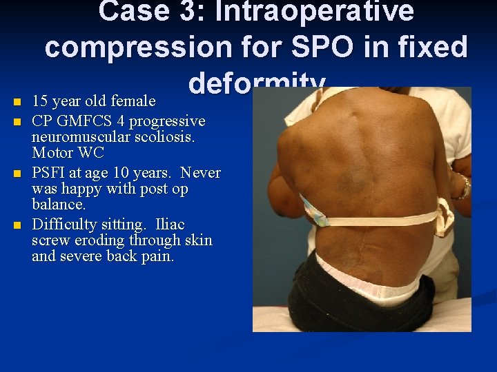 n n Case 3: Intraoperative compression for SPO in fixed deformity 15 year old n n Case 3: Intraoperative compression for SPO in fixed deformity 15 year old