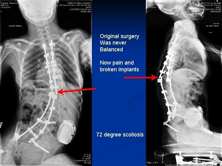 Original surgery Was never Balanced Now pain and broken implants 72 degree scoliosis Original surgery Was never Balanced Now pain and broken implants 72 degree scoliosis
