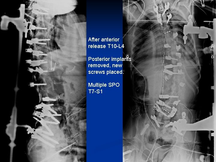 After anterior release T 10 -L 4 Posterior implants removed, new screws placed. Multiple After anterior release T 10 -L 4 Posterior implants removed, new screws placed. Multiple