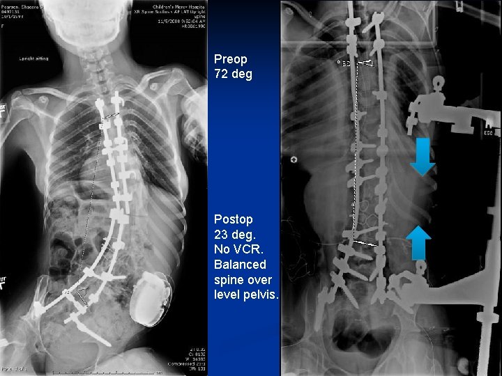 Preop 72 deg Postop 23 deg. No VCR. Balanced spine over level pelvis. Preop 72 deg Postop 23 deg. No VCR. Balanced spine over level pelvis.