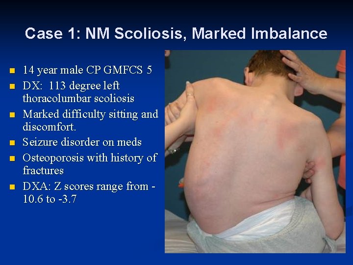 Case 1: NM Scoliosis, Marked Imbalance n n n 14 year male CP GMFCS Case 1: NM Scoliosis, Marked Imbalance n n n 14 year male CP GMFCS