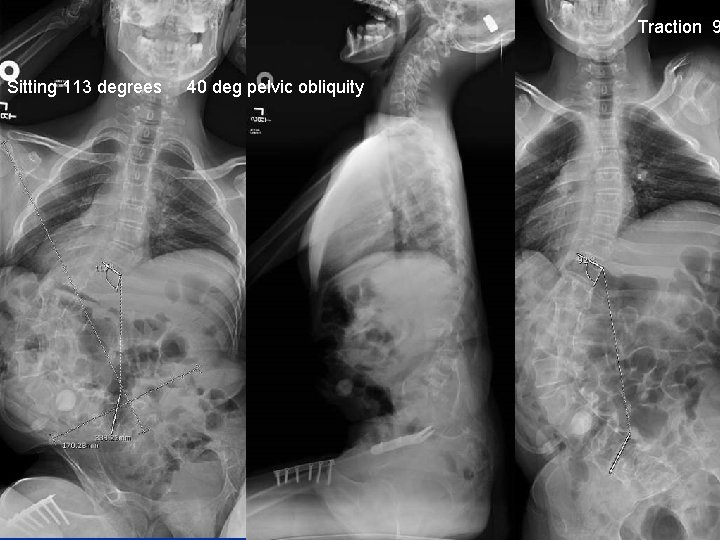 Traction 9 Sitting 113 degrees 40 deg pelvic obliquity Traction 9 Sitting 113 degrees 40 deg pelvic obliquity