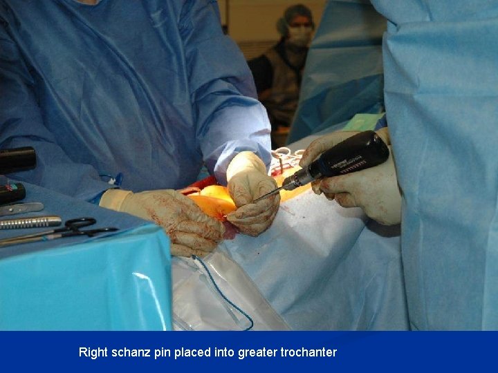 Right schanz pin placed into greater trochanter Right schanz pin placed into greater trochanter