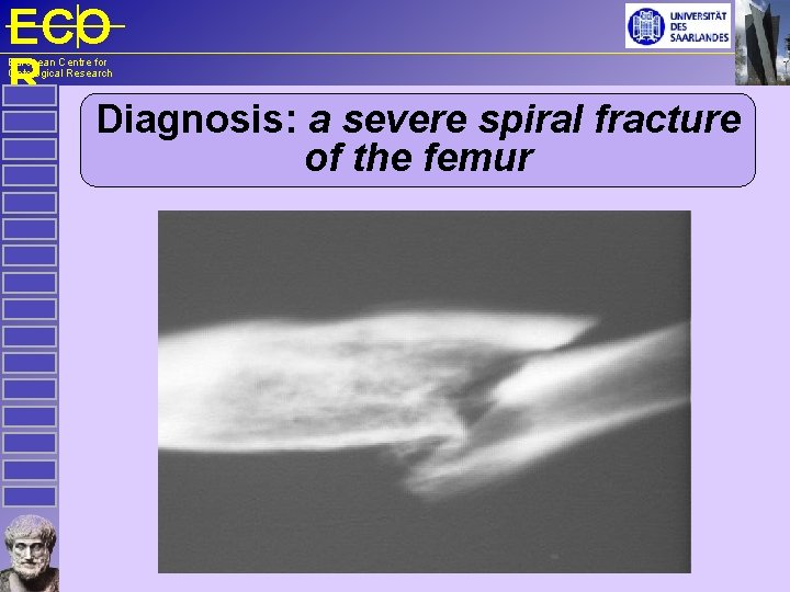 ECO R European Centre for Ontological Research Diagnosis: a severe spiral fracture of the