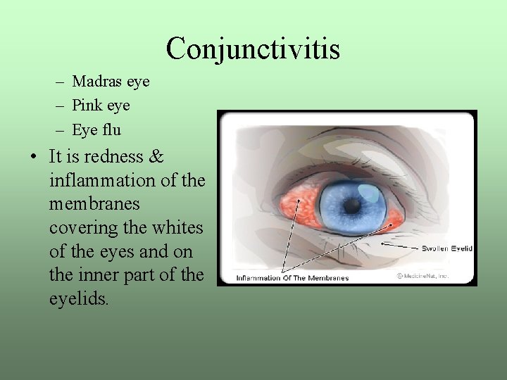 Conjunctivitis – Madras eye – Pink eye – Eye flu • It is redness