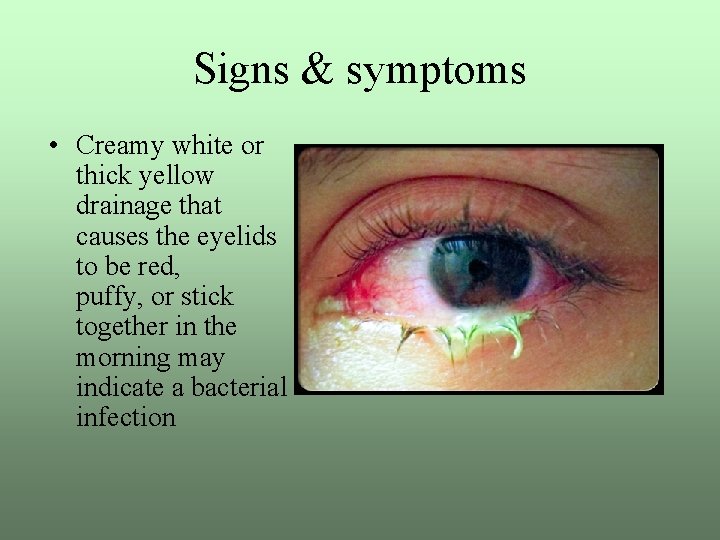 Signs & symptoms • Creamy white or thick yellow drainage that causes the eyelids