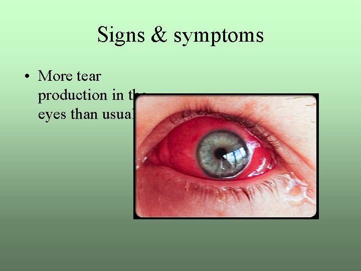 Signs & symptoms • More tear production in the eyes than usual 