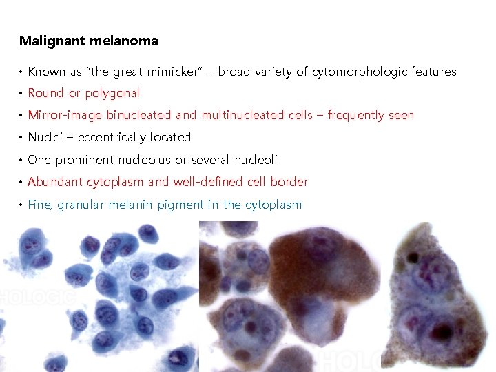 Malignant melanoma • Known as “the great mimicker” – broad variety of cytomorphologic features