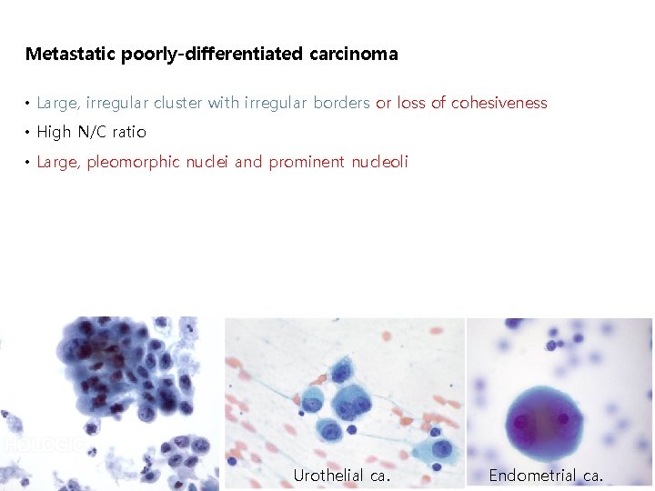 Metastatic poorly-differentiated carcinoma • Large, irregular cluster with irregular borders or loss of cohesiveness