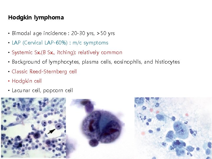 Hodgkin lymphoma • Bimodal age incidence : 20 -30 yrs, >50 yrs • LAP Hodgkin lymphoma • Bimodal age incidence : 20 -30 yrs, >50 yrs • LAP