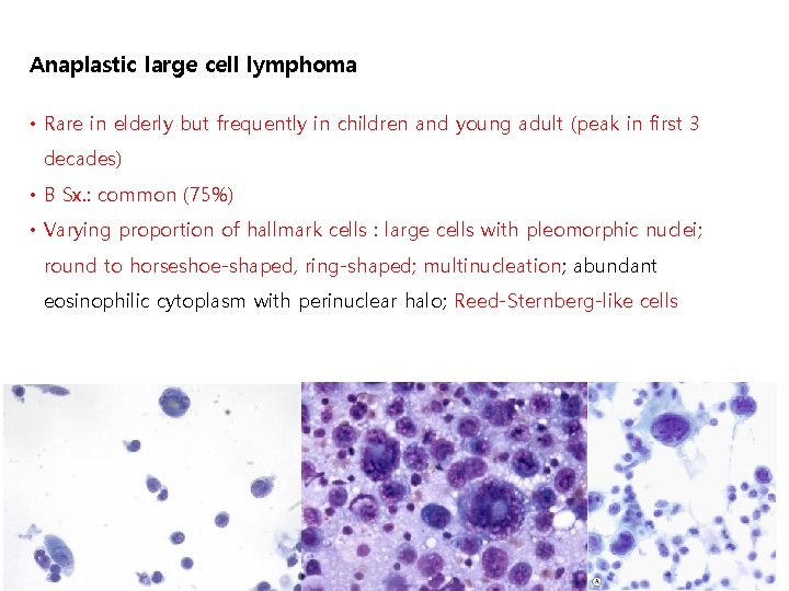 Anaplastic large cell lymphoma • Rare in elderly but frequently in children and young
