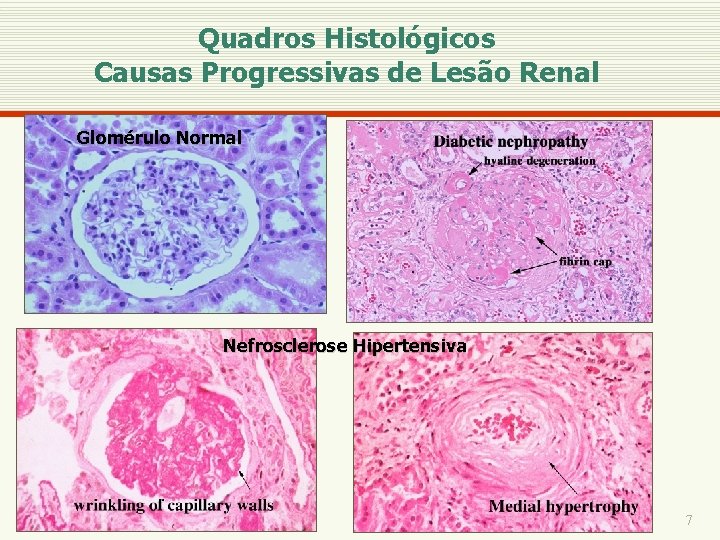 Quadros Histológicos Causas Progressivas de Lesão Renal Glomérulo Normal Nefrosclerose Hipertensiva 7 