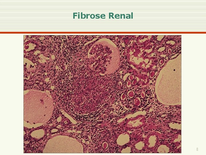 Fibrose Renal 8 