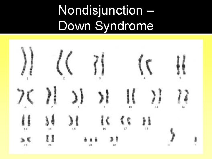 Nondisjunction – Down Syndrome 