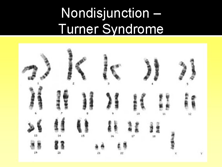 Nondisjunction – Turner Syndrome 