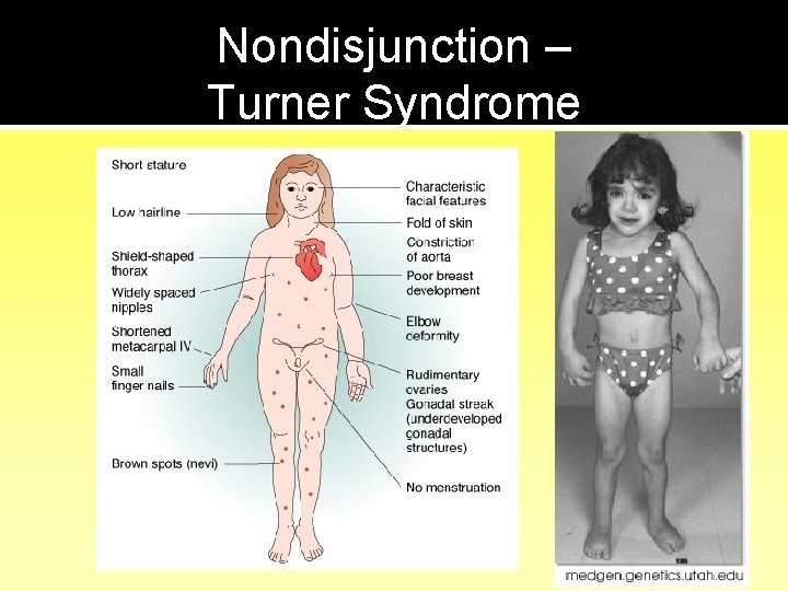Nondisjunction – Turner Syndrome 