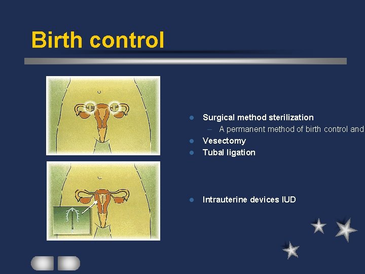 Birth control l Surgical method sterilization – A permanent method of birth control and
