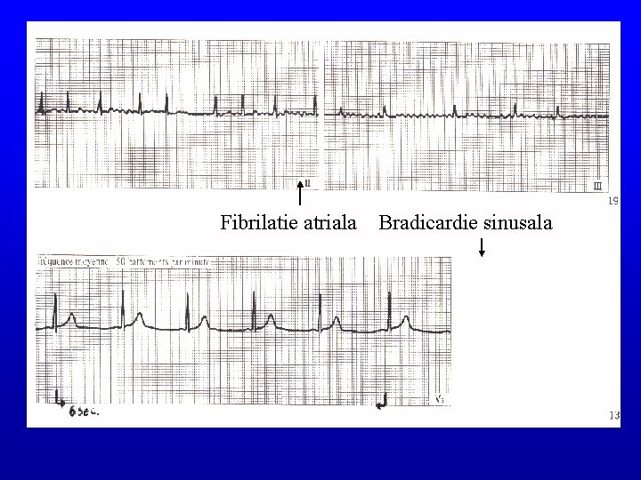 Fibrilatie atriala Bradicardie sinusala 