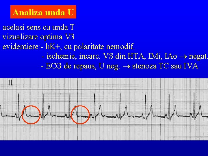 Analiza unda U acelasi sens cu unda T vizualizare optima V 3 evidentiere: -