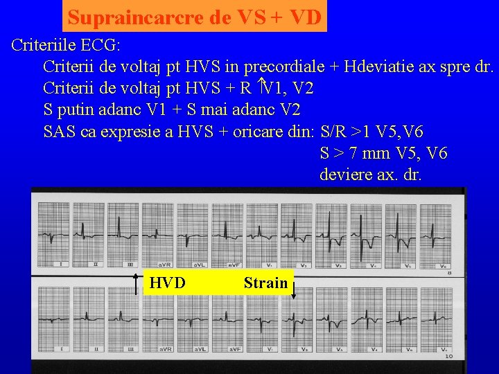 Supraincarcre de VS + VD Criteriile ECG: Criterii de voltaj pt HVS in precordiale