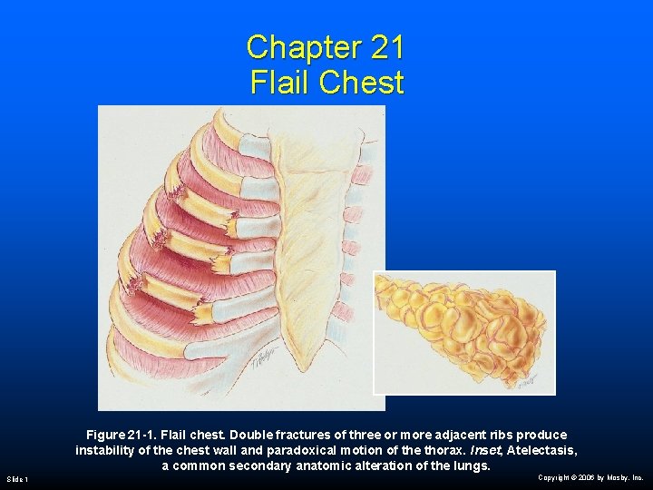 Chapter 21 Flail Chest Figure 21 -1. Flail chest. Double fractures of three or