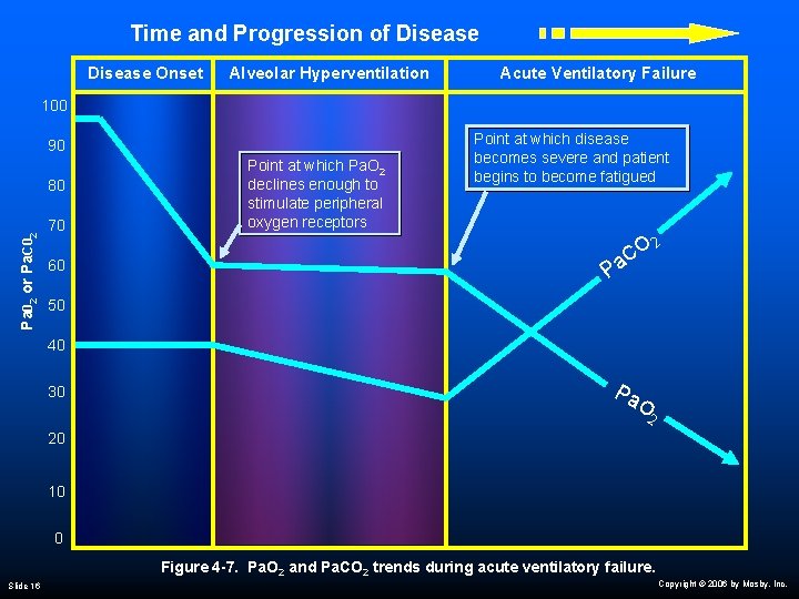 Time and Progression of Disease Onset Alveolar Hyperventilation Acute Ventilatory Failure 100 90 Pa