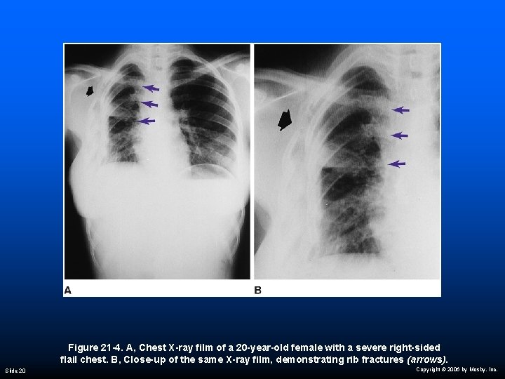 Figure 21 -4. A, Chest X-ray film of a 20 -year-old female with a