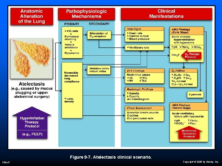 Figure 9 -7. Atelectasis clinical scenario. Slide 5 Copyright © 2006 by Mosby, Inc.