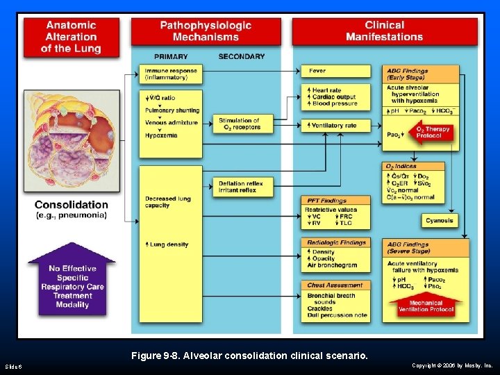 Figure 9 -8. Alveolar consolidation clinical scenario. Slide 6 Copyright © 2006 by Mosby,