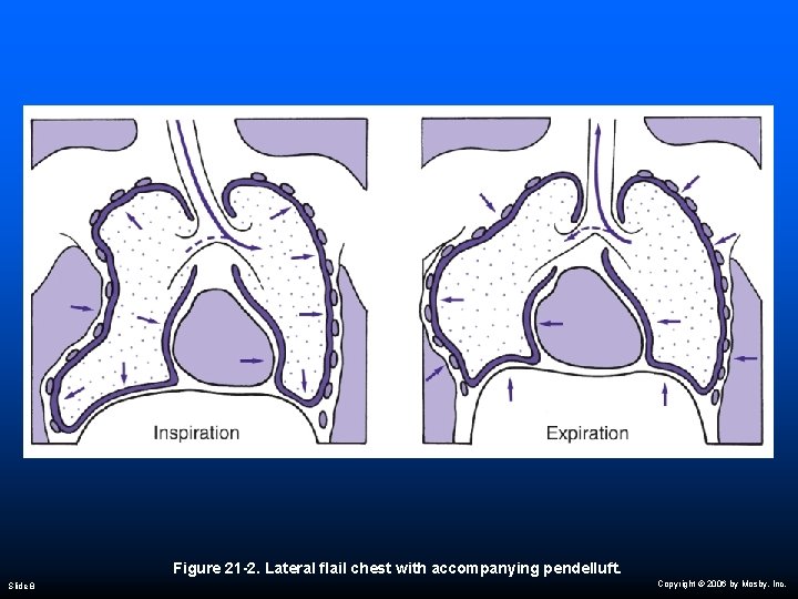 Figure 21 -2. Lateral flail chest with accompanying pendelluft. Slide 8 Copyright © 2006