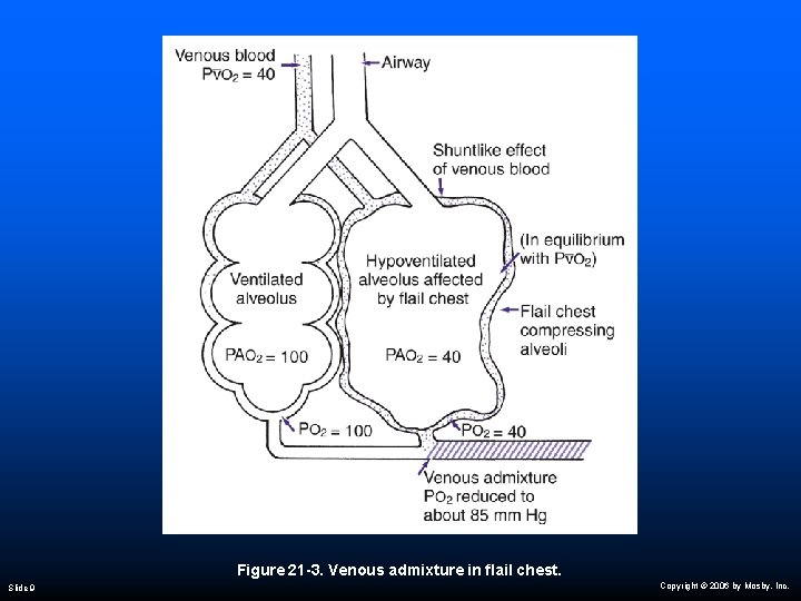 Figure 21 -3. Venous admixture in flail chest. Slide 9 Copyright © 2006 by